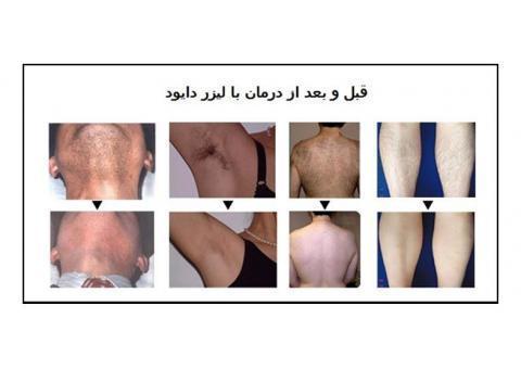 لیزر دایود(DIODE LASER)