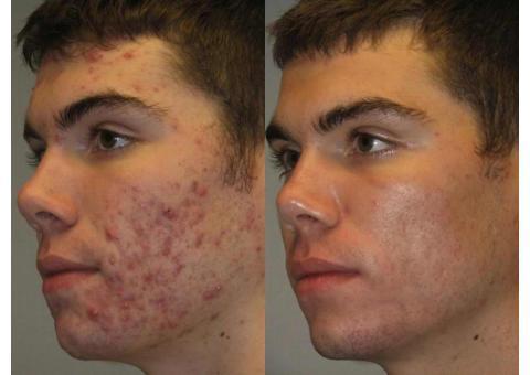 لیزرجوش و زخم های پوستی و لیفت صورت جردن