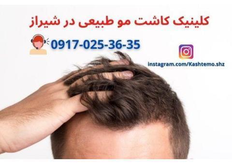 کاشت موی طبیعی در شیراز