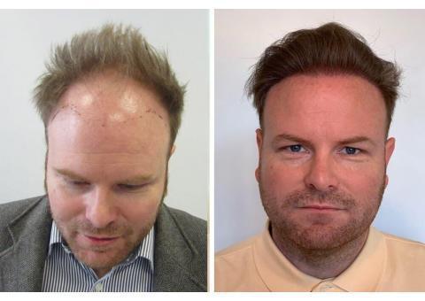 کاشت مو تنها با دو و نیم میلیون تومان