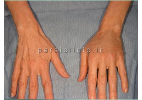 تزریق چربی به روش نانوفت