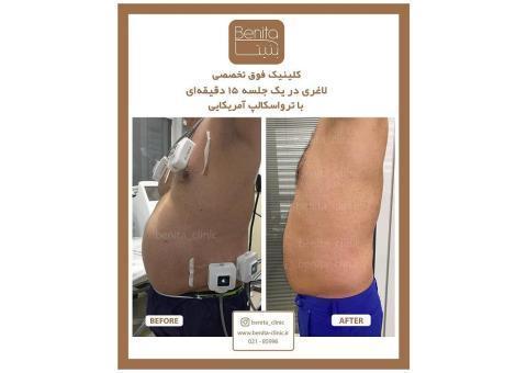 قیمت لاغری با ترواسکالپ