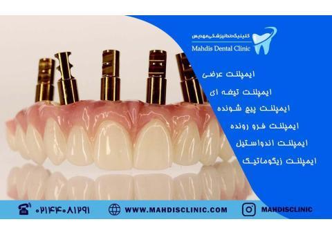 خدمات ایمپلنت - لمینت - دندانپزشکی زیبایی در تهران