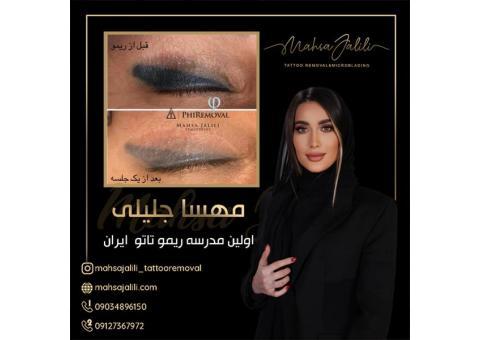 اموزش ریموو تاتو خط چشم به صورت حرفه ای