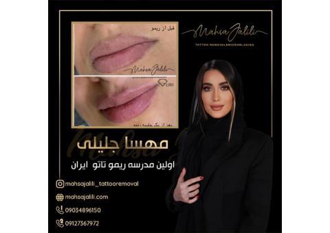 ریموو تاتو خط لب با مادر ریموو تاتو ایران