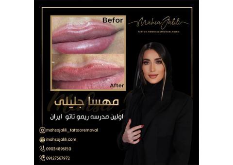 ریموو تاتو خط لب با مادر ریموو تاتو ایران