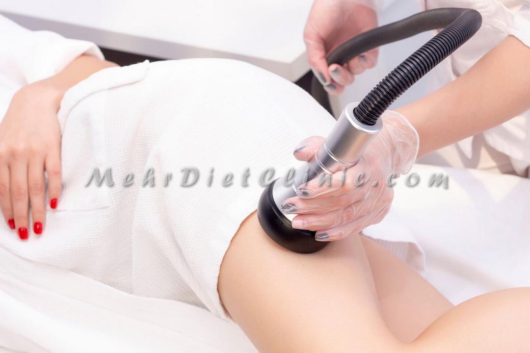 دستگاه لاغری کویتیشن