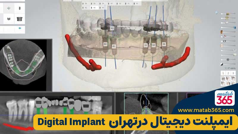 مطب 365 | ایمپلنت دیجیتال در تهران