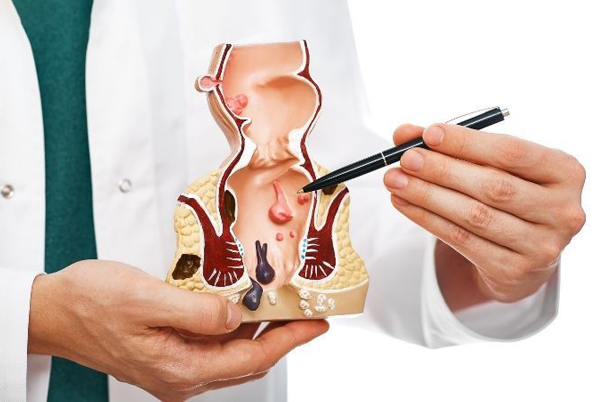 درمان انواع بیماری های مقعدی با یک جلسه لیزر