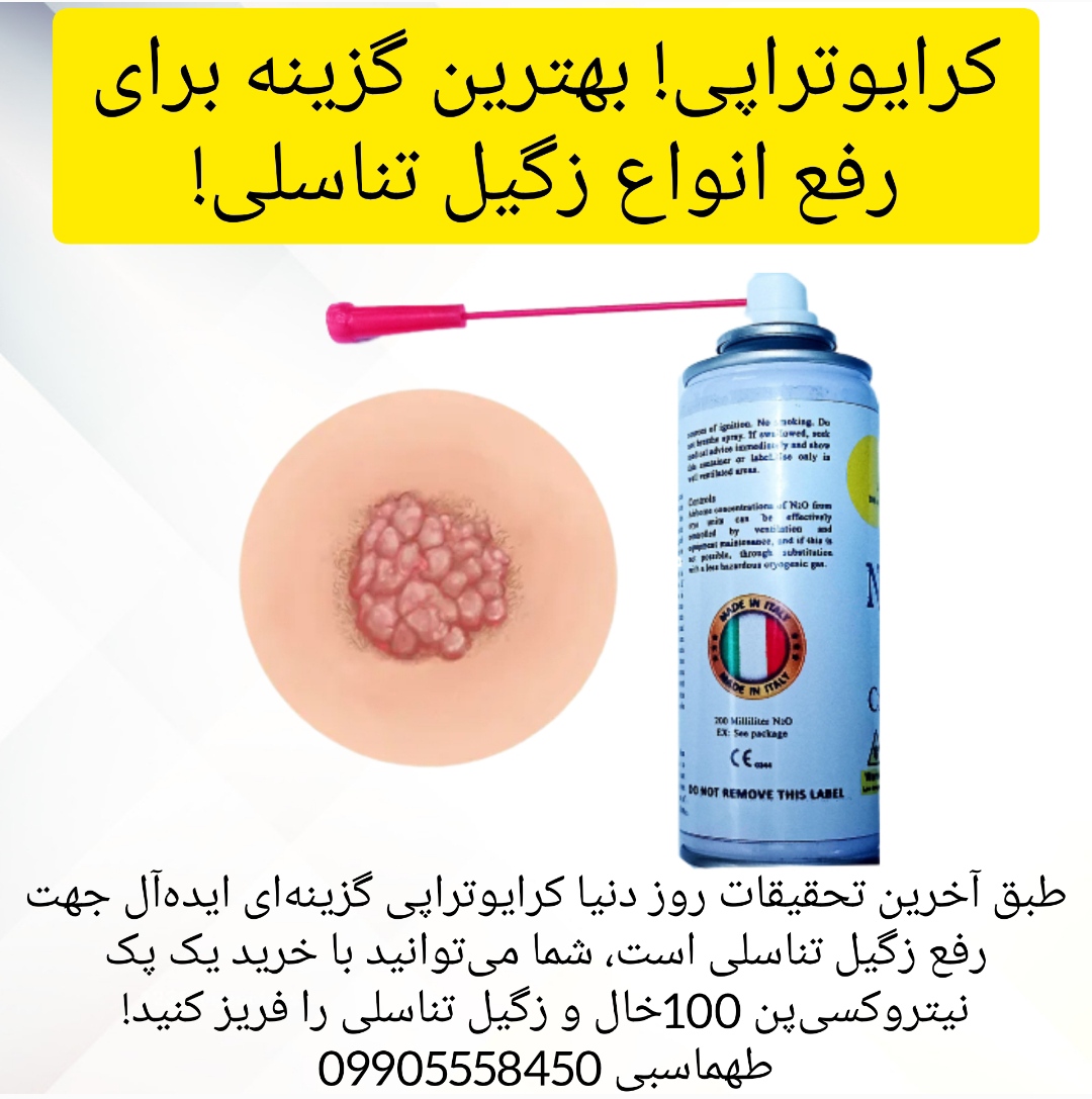 اسپری کرایوتراپی نیتروکسی، درمان زگیل تناسلی