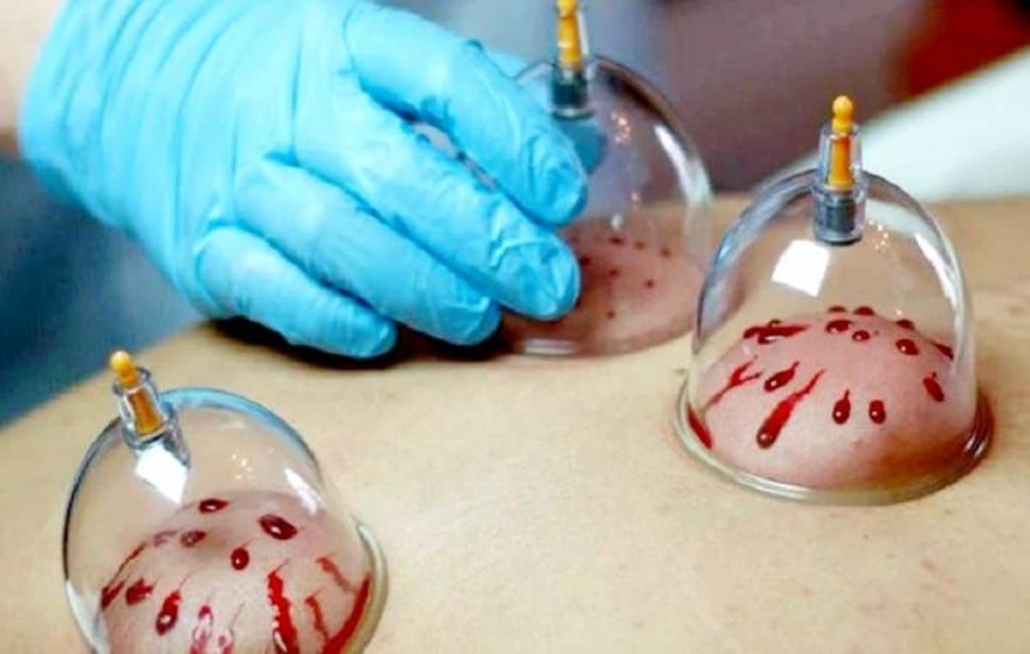 آموزش تزریقات طب سوزنی حجامت