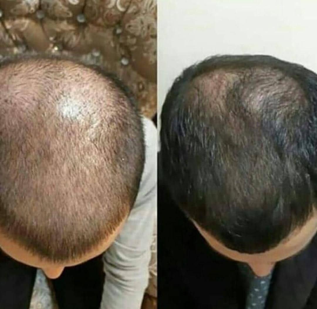 اسپری قطع ریزش و رویش مجدد مو