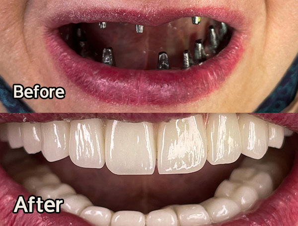 لمینت دندان در تهران