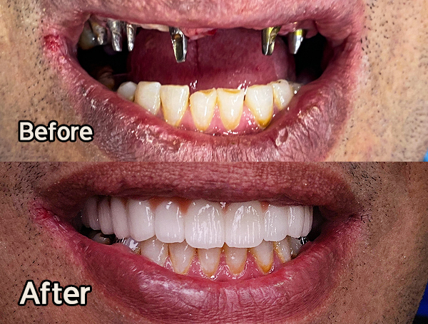 ایمپلنت ارزان | کلینیک دندانپزشکی میلان