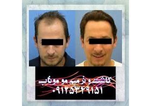 ترمیم مو بدون جراحی